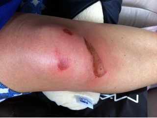 Illustration for article titled Erin Andrews Has Been Posting Pictures Of Various Bruises In Recent Days